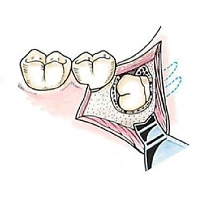 親知らずの周りの骨を削り、歯の歯冠部分を露出させます