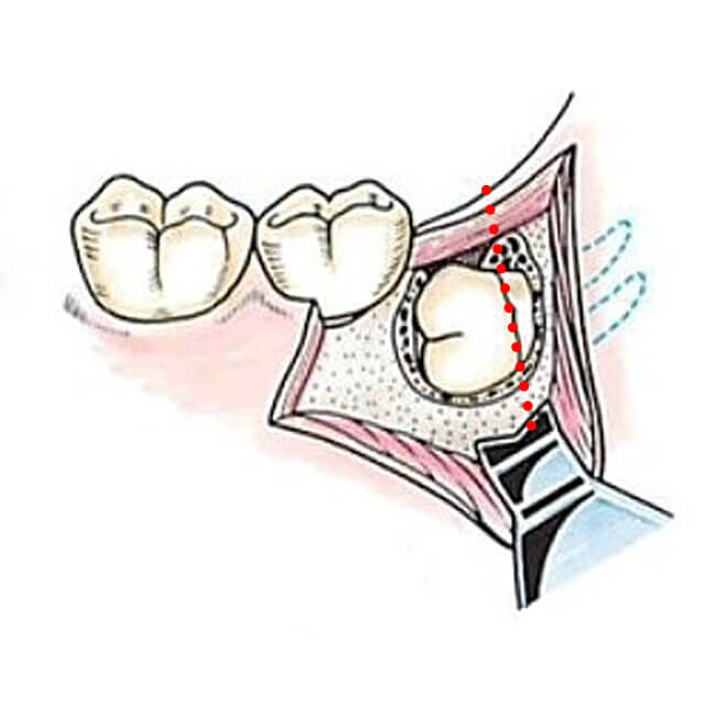 埋伏歯の歯冠をタービンで分割し除去します